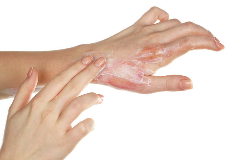 CIPHE: Scalds and burns cost the NHS millions