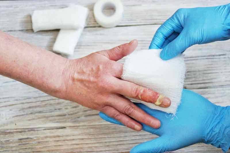 Burn admissions rise during lockdown