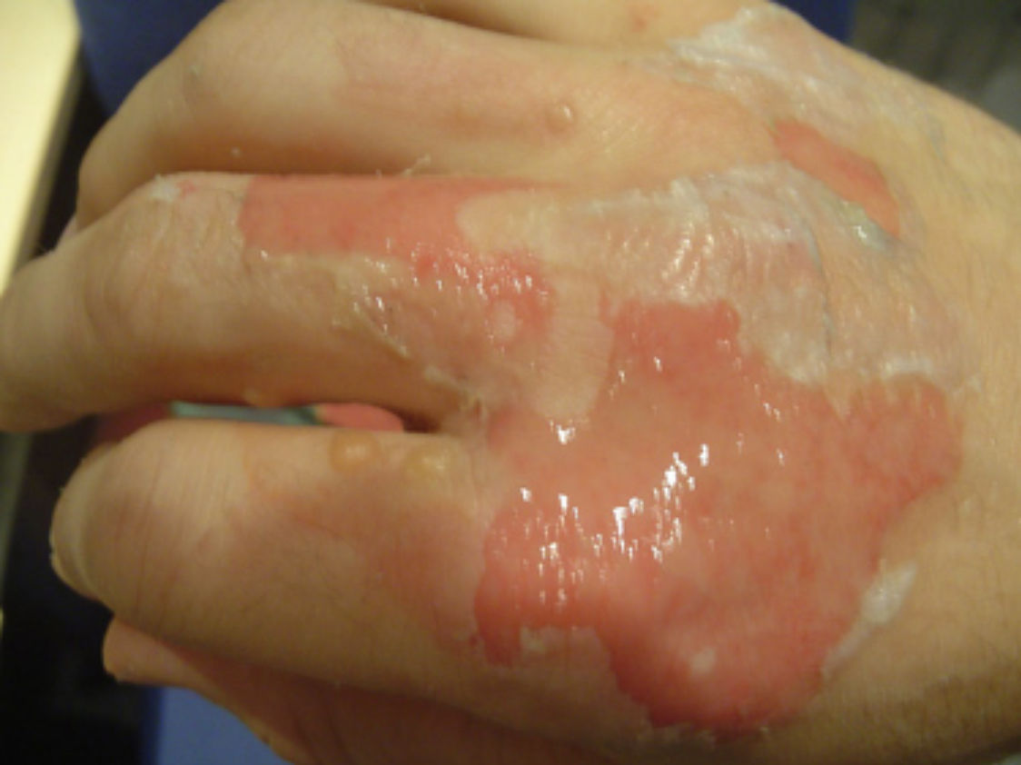 Warning of burn risk and hand sanitiser